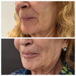 20245 04 14 Qué es una armonización facial (4)